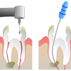640px-Root_Canal_Illustration_Molar.svg_ 640px-Root_Canal_Illustration_Molar.svg_