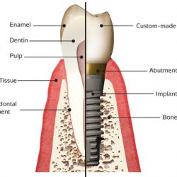 Implant Implant